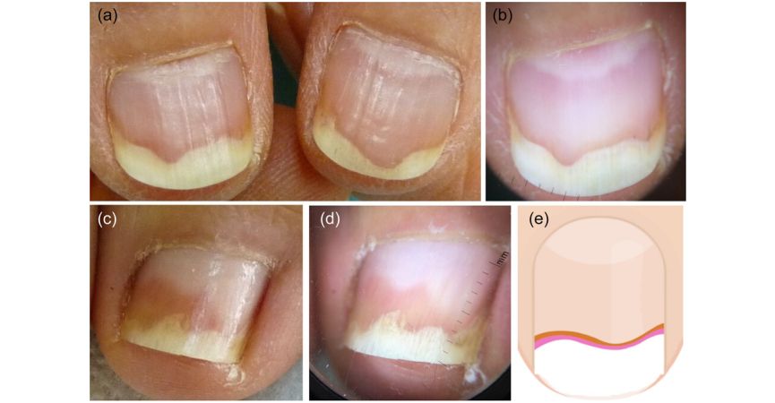 Onycholiza paznokcia - co to jest i jak ją leczyć ?