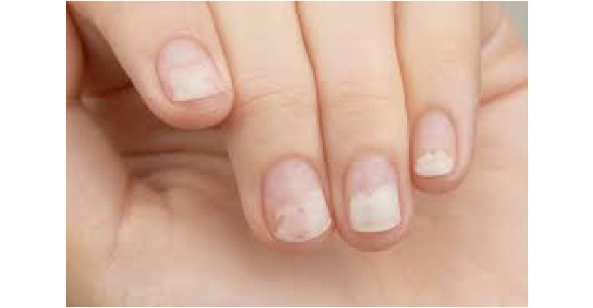 Najczęściej zadawane pytania • ONYGEN® krem na onycholizę paznokcia firmy Podopharm