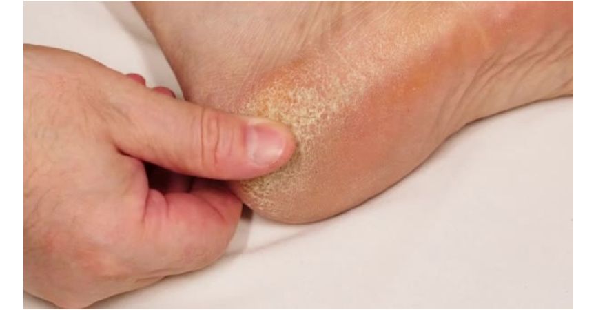 Najczęstsze problemy skórne stóp – jak skutecznie je rozwiązać z pomocą PODOPHARM?