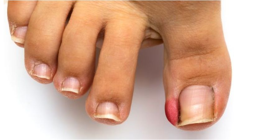 Wrastające paznokcie - jak sobie z nimi radzić