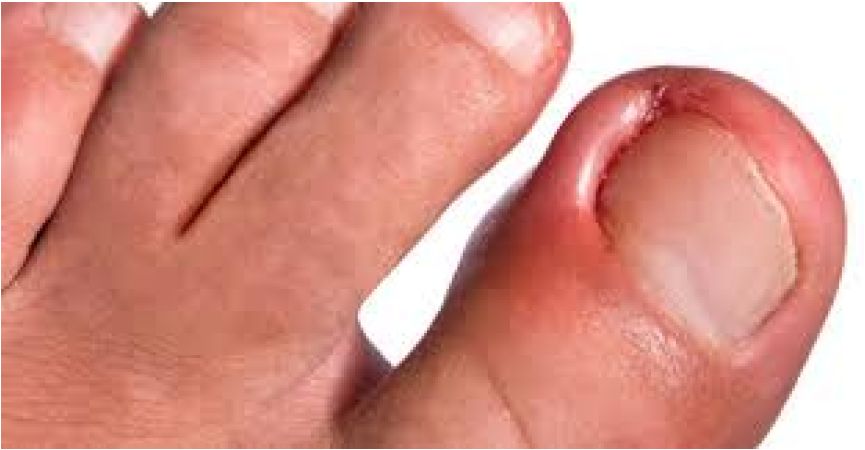 Wrastające paznokciem – skuteczne wsparcie z Podopharm Podoflex