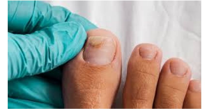 Onycholiza paznokcia – jak skutecznie leczyć oraz wzmocnić paznokcie? Kompletny poradnik