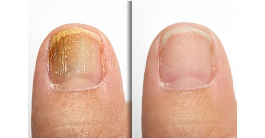 Grzybicę paznokci, czyli onychomycosis