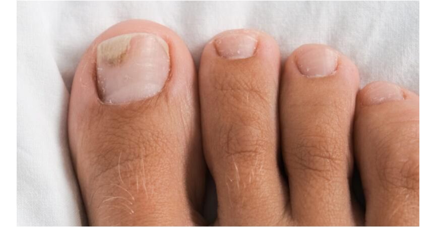 Onycholiza paznokcia – jak radzić sobie w domu? Kompletny poradnik + polecane produkty